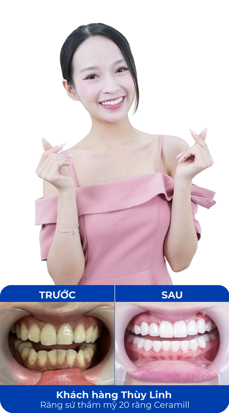 Ảnh trước và sau khi làm răng tại SC Dental