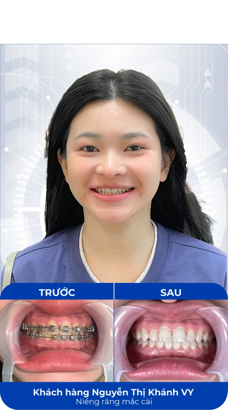 Ảnh trước và sau khi làm răng tại SC Dental