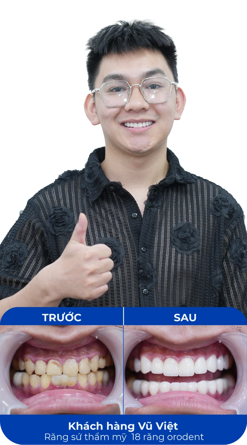 Ảnh trước và sau khi làm răng tại SC Dental