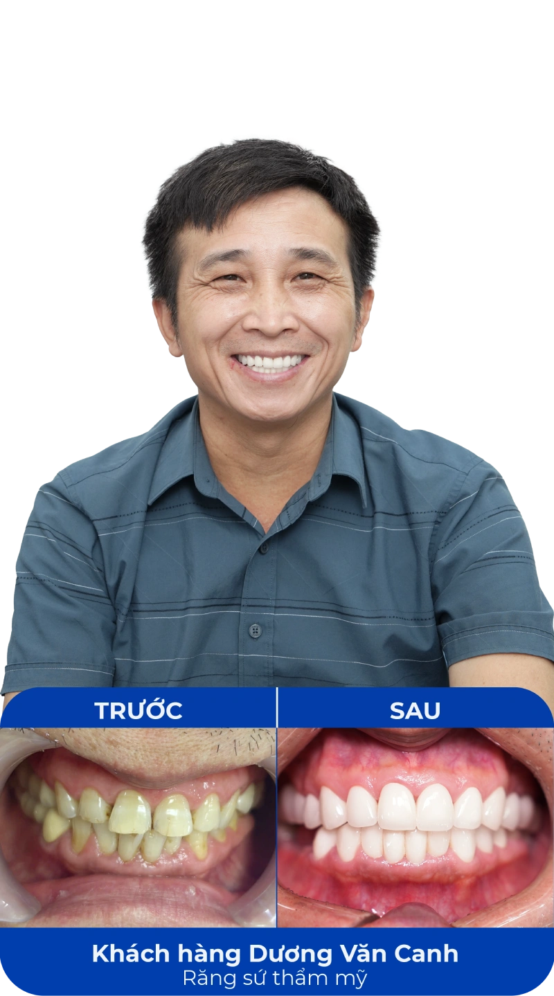 Ảnh trước và sau khi làm răng tại SC Dental