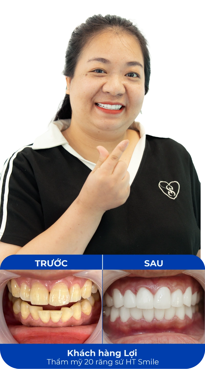 Ảnh trước và sau khi làm răng tại SC Dental