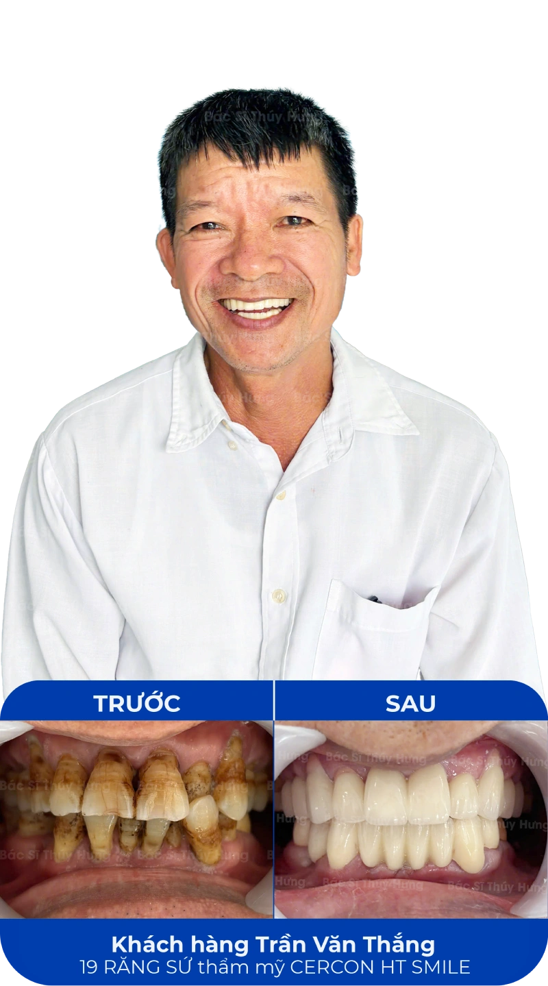 Ảnh trước và sau khi làm răng tại SC Dental