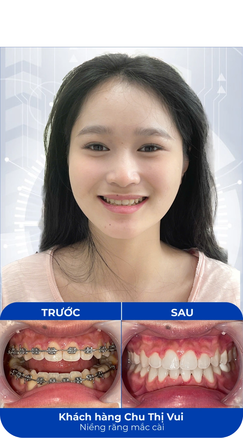 Ảnh trước và sau khi làm răng tại SC Dental