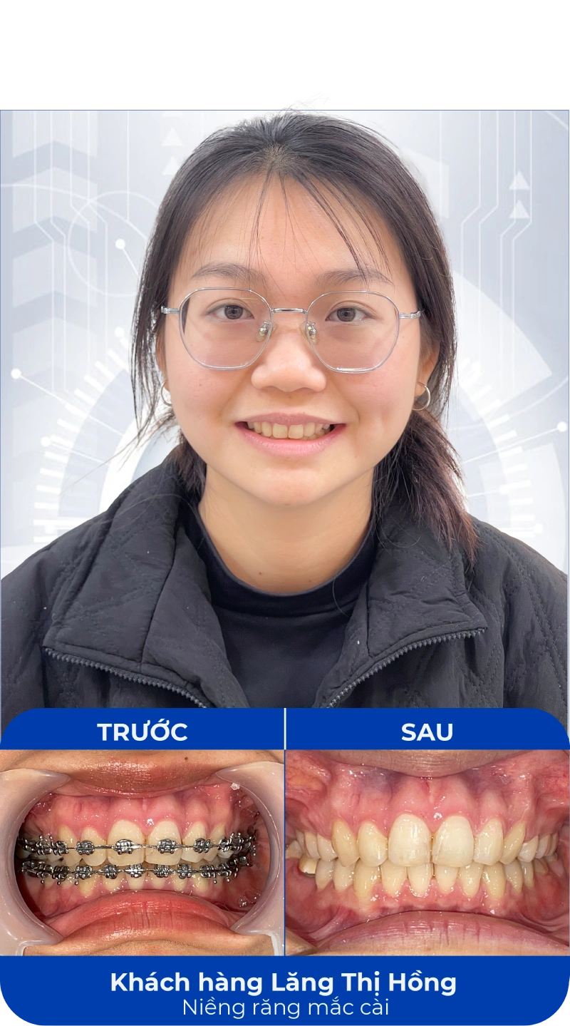 Ảnh trước và sau khi làm răng tại SC Dental